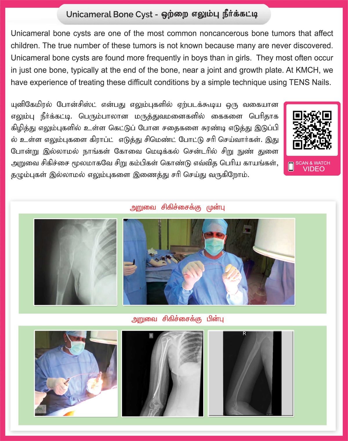Unicameral Bone Cyst